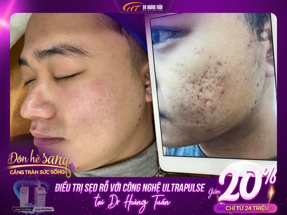 trị sẹo rỗ bằng laser có hết không